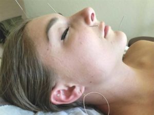 Santa Cruz Family Acupuncture Face Needles