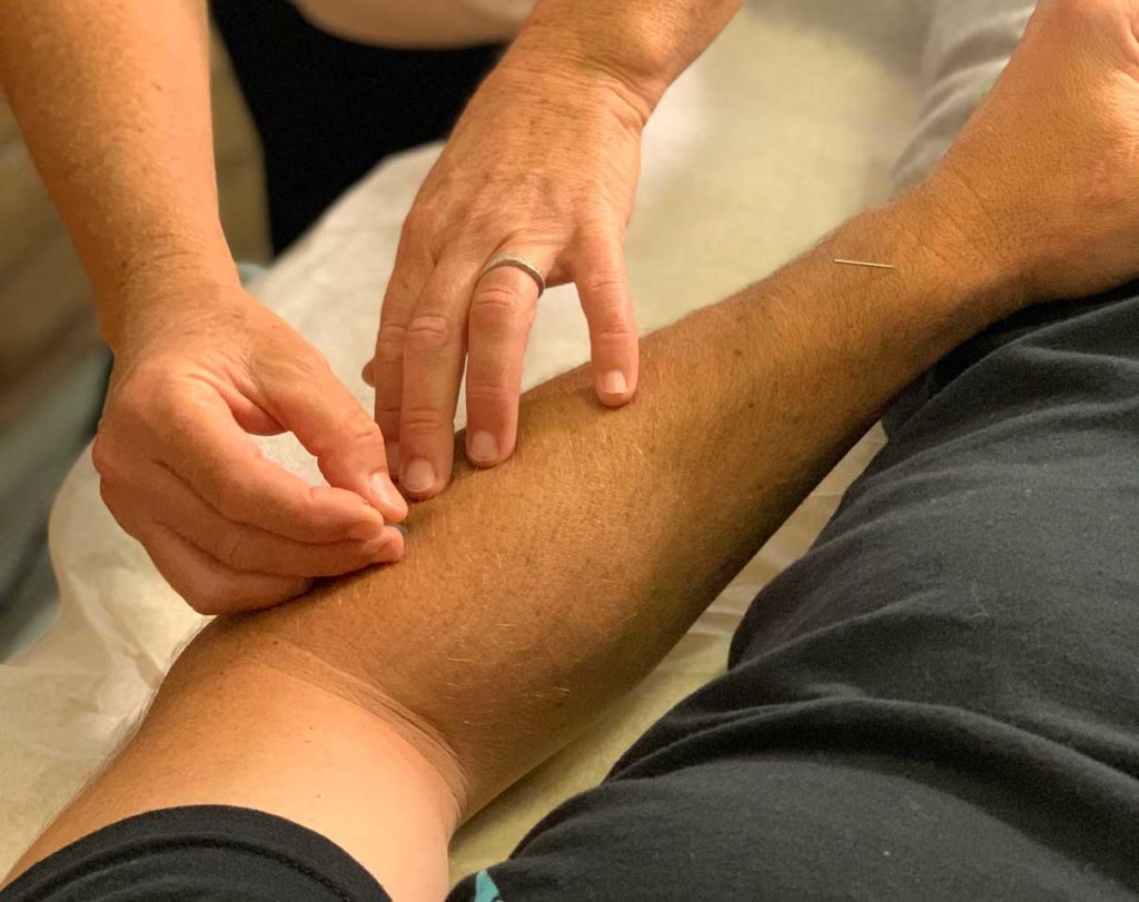 Santa Cruz Family Acupuncture Placing Needles in Arm