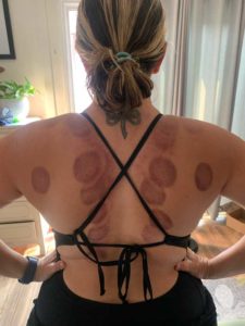Santa Cruz Family Acupuncture Back Cupping Marks