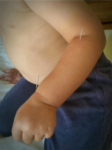 Santa Cruz Family Acupuncture – Pediatric Acupuncture