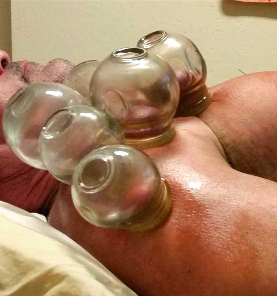 Santa Cruz Family Acupuncture Services Cupping