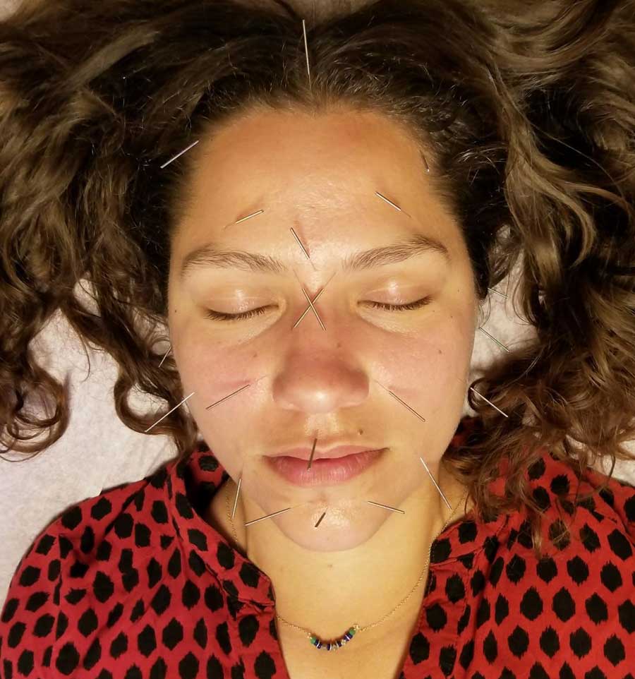 Santa Cruz Family Acupuncture Services Facial Rejuvenation